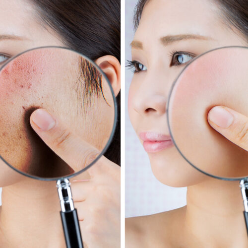 Laserowe usuwanie przebarwień – niezawodna technika na promienną i jednolitą skórę