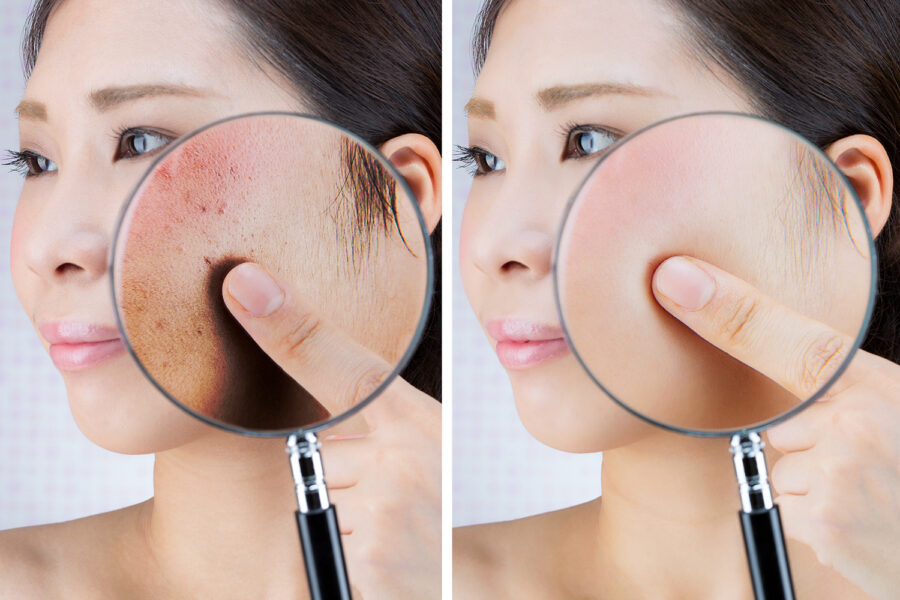 Laserowe usuwanie przebarwień – niezawodna technika na promienną i jednolitą skórę